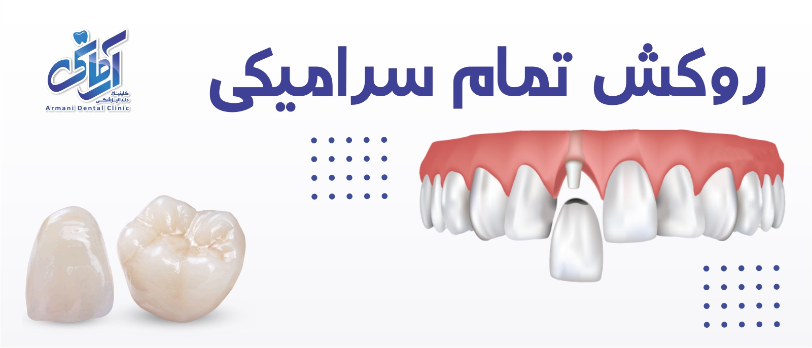 full-ceramic-banner بنر روکش تمام سرامیکی