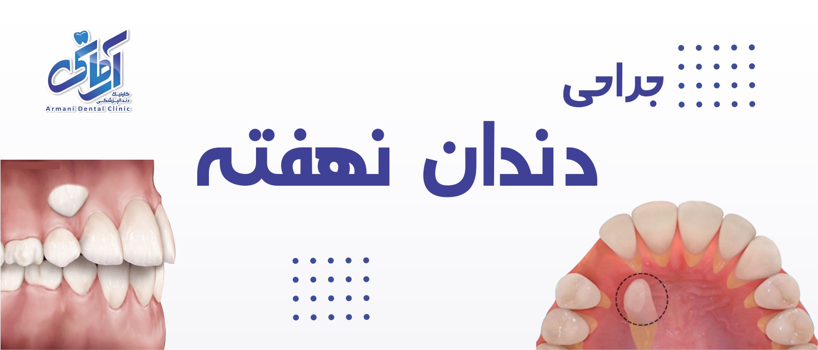 hide-dent-banner جراحی دندان نهفته