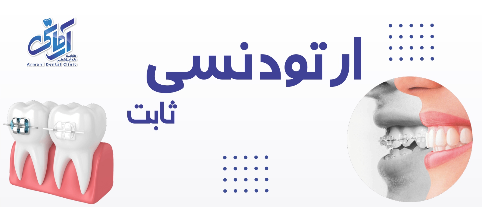 ortodentic-fix-banner ارتودنسی ثابت