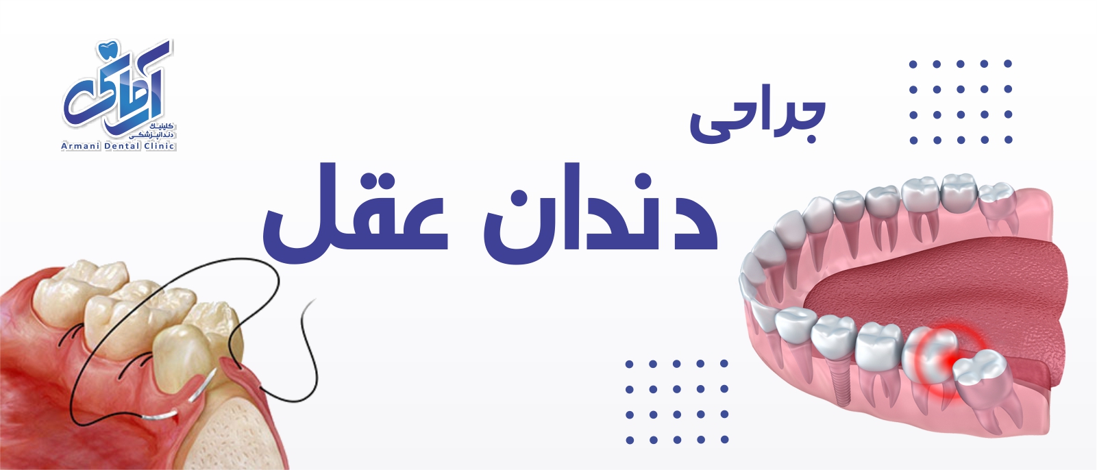 Wisdom tooth-banner جراحی دندان عقل