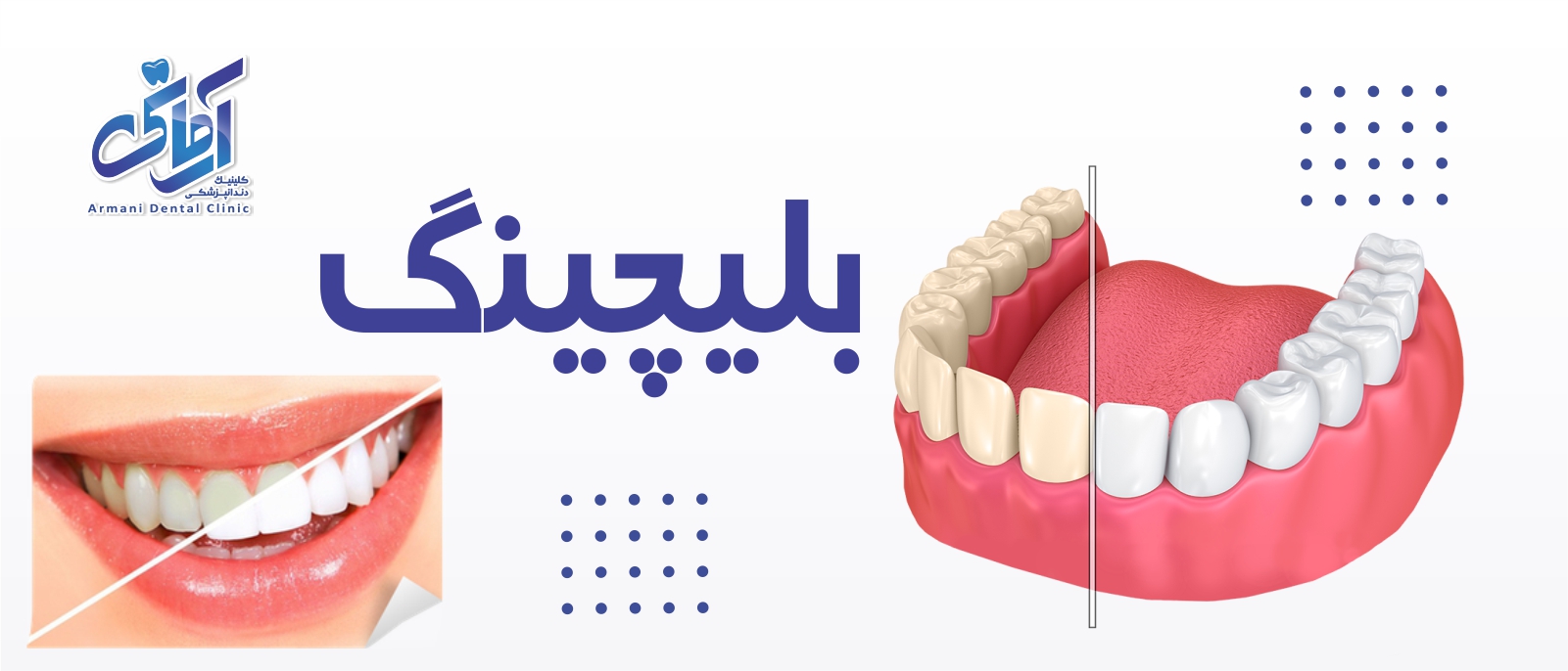 bleach-teeth بلیچینگ