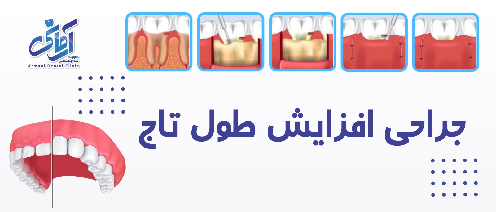 crownLengthening-banner جراحی افزایش طول تاج