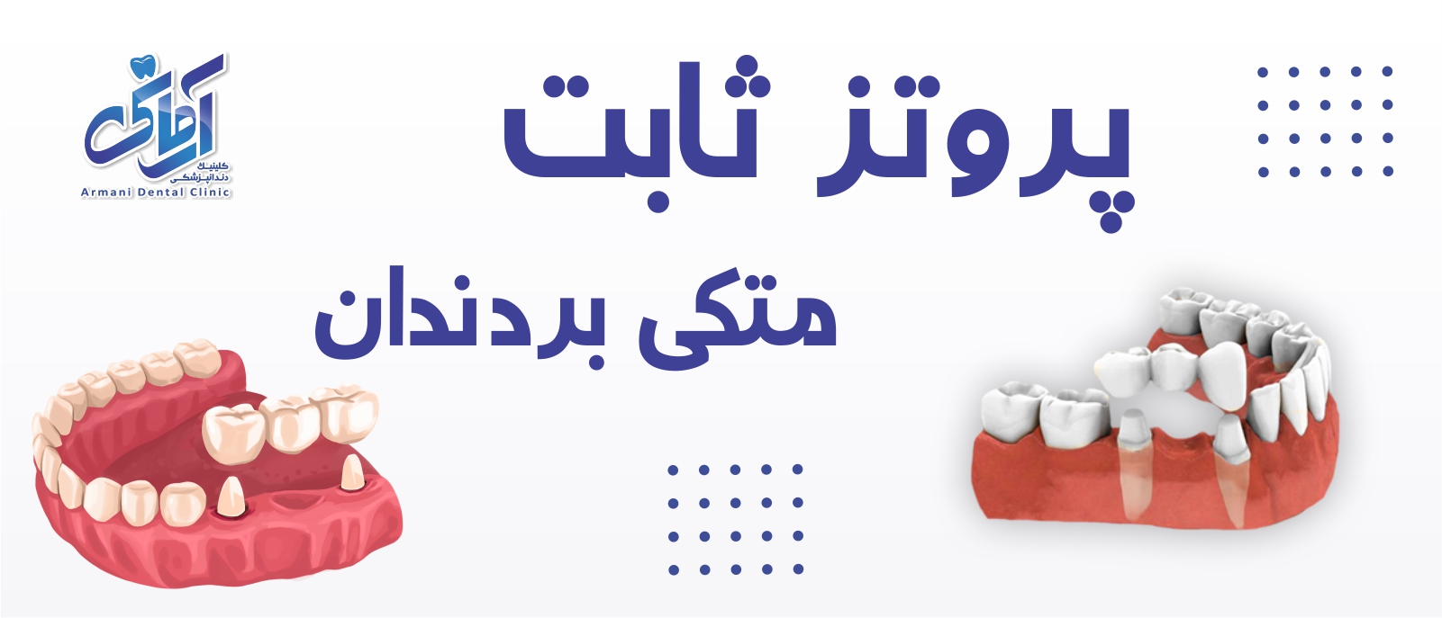 dental-fixed-prosthesis-banner پروتز ثابت متکب یر دندان