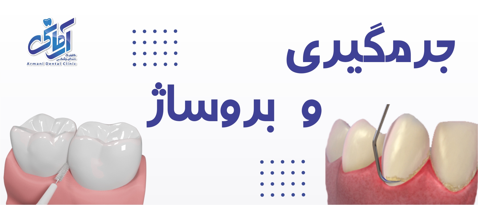 dental-plaque-removal-banner (1) جرمگیری و بروساژ