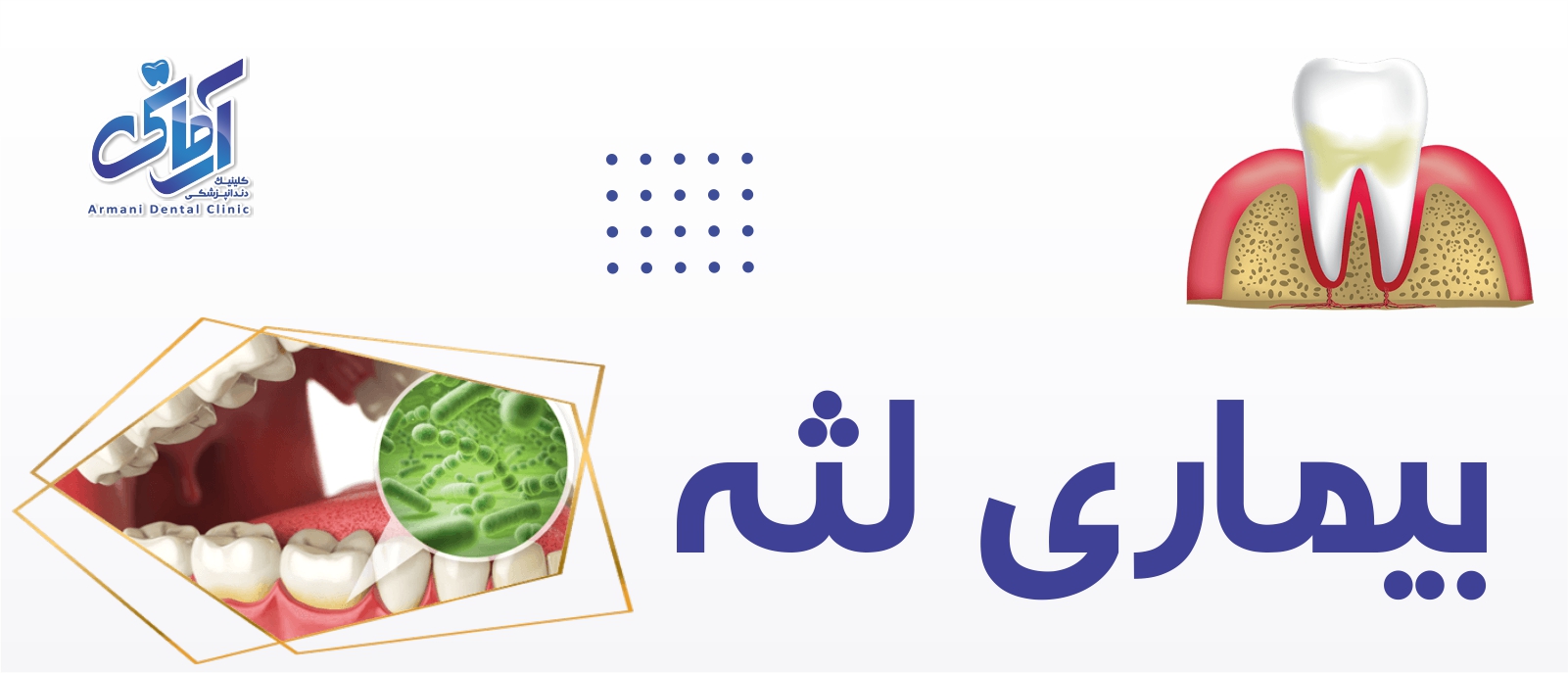 gum-disease-banner بیماری لثه