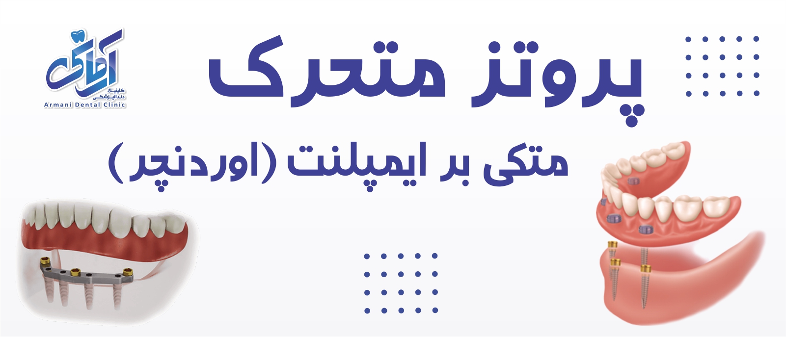 overdenture-implant-banner پروتز متحرک