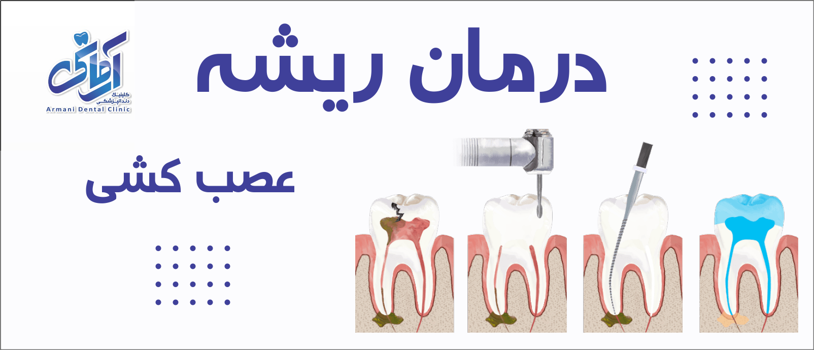 root-canal درمان ریشه عصب کشی