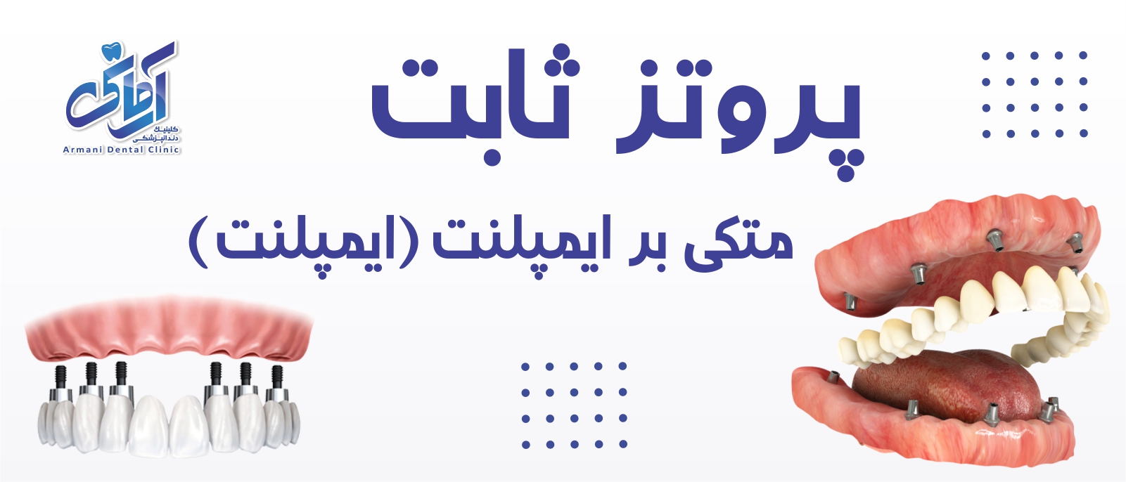 implant-fixed-prosthesis-banner پروتز ثابت متکی بر ایمپلنت