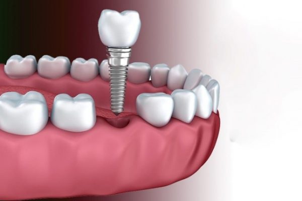 ایمپلنت دندان جایگزین