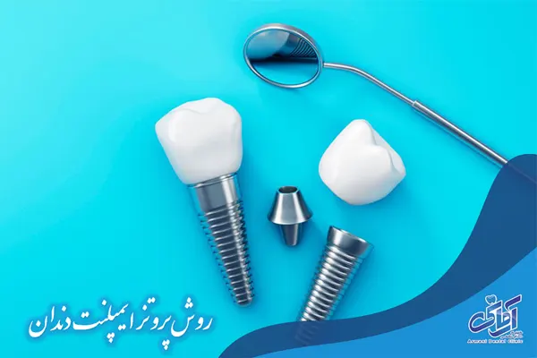 روش پروتز های ثابت متکی بر ایمپلنت