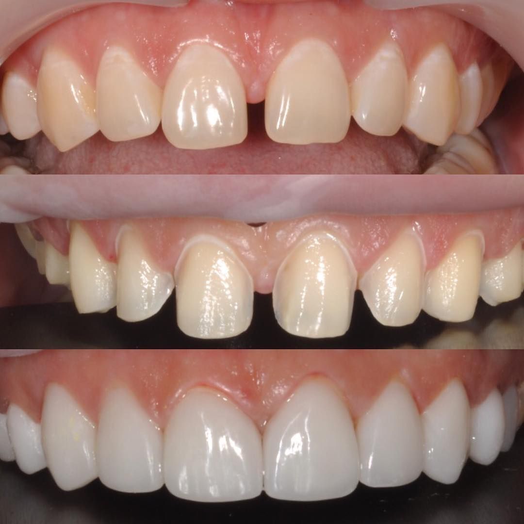درمان فاصله بین دندان ها و کامپوزیت ونیر