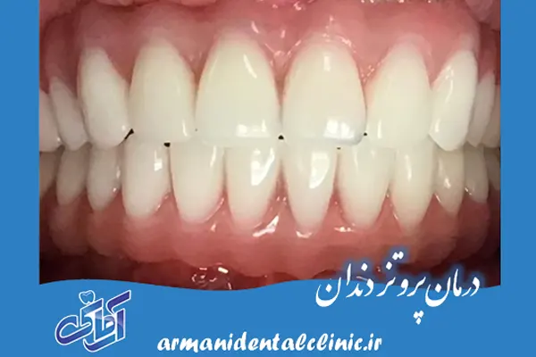 درمان پروتز دندان