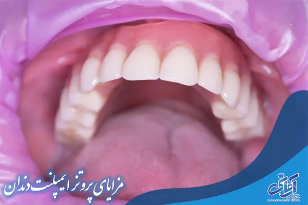 مزایای پروتز ایمپلنت دندان 