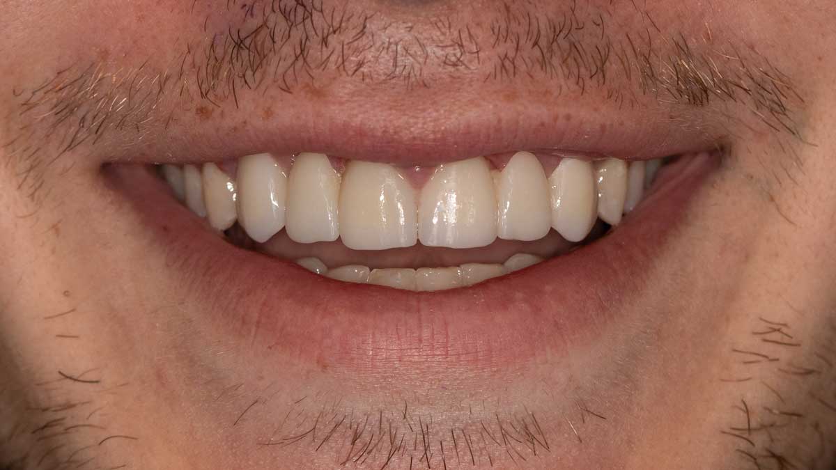 بعد از پل دندان