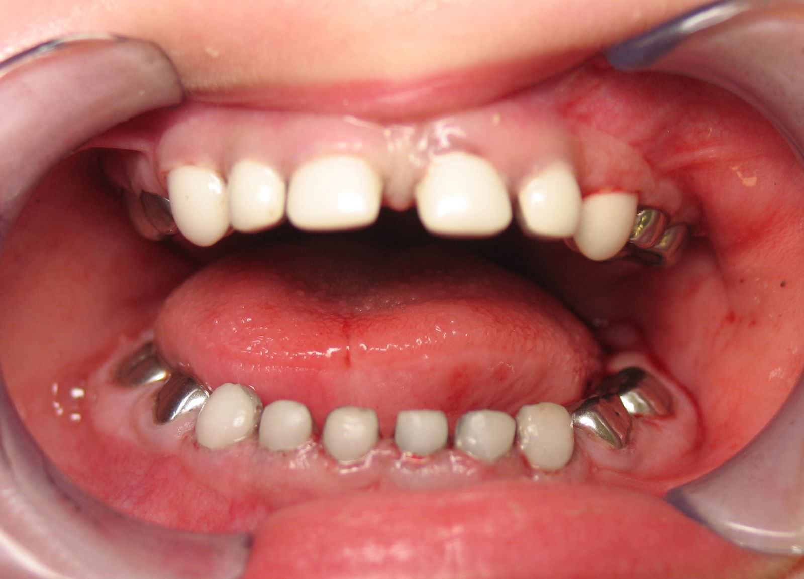 روکش استیل دندان های شیری (SSC)