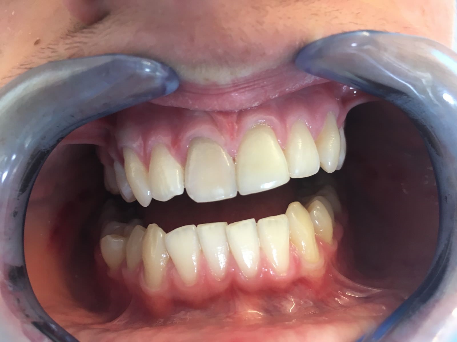 مراقبت پس از درمان ترمیم دندان 