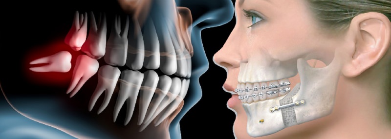 جراحی فک و صورت دندان عقل و پلاتین