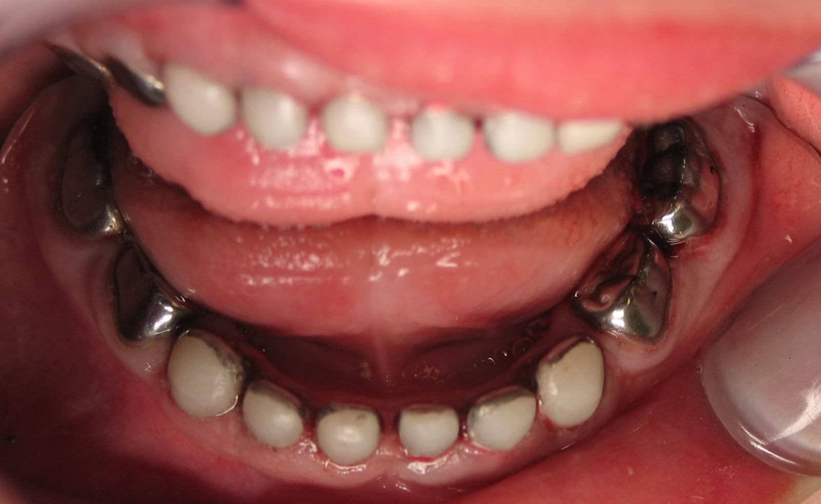 پس از درمان روکش استیل دندان های شیری (SSC)