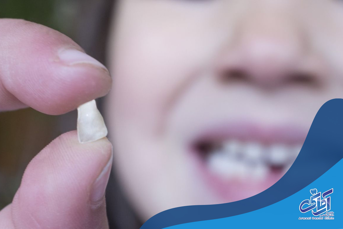 چند دندان شیری را می‌توان هم‌زمان کشید؟