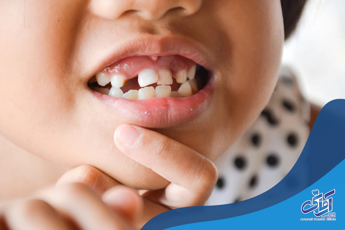 روند کشیدن دندان شیری چگونه انجام می‌شود؟