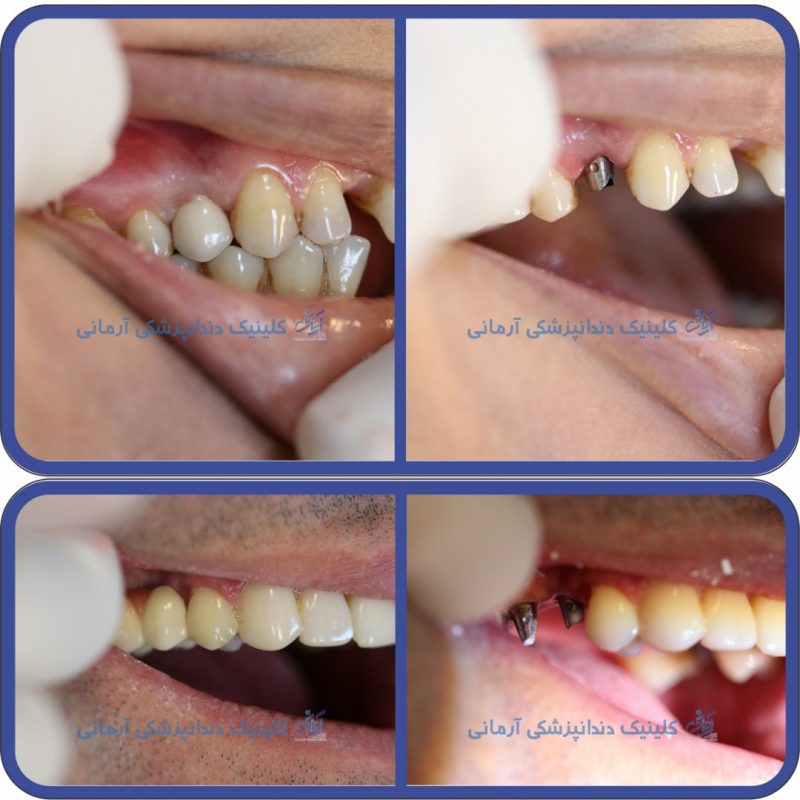 طرح درمان ایمپلنت دندان جایگزین