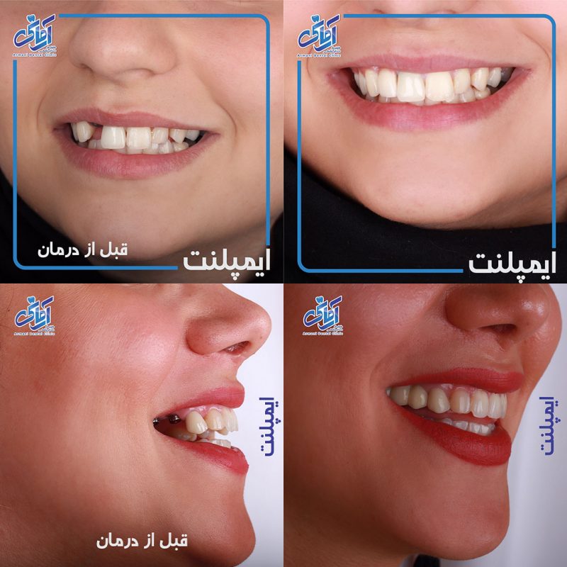 طرح درمان ایمپلنت دندان
