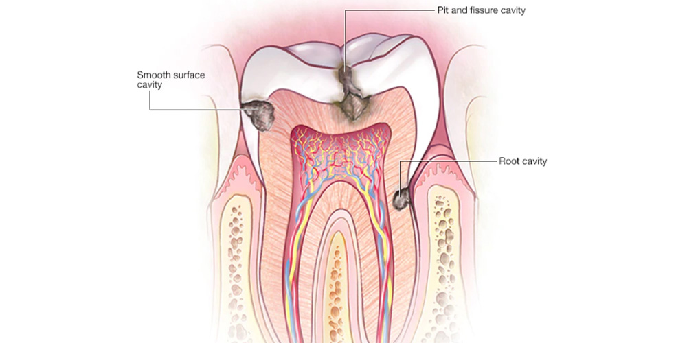 تشخیص پوسیدگی دندان