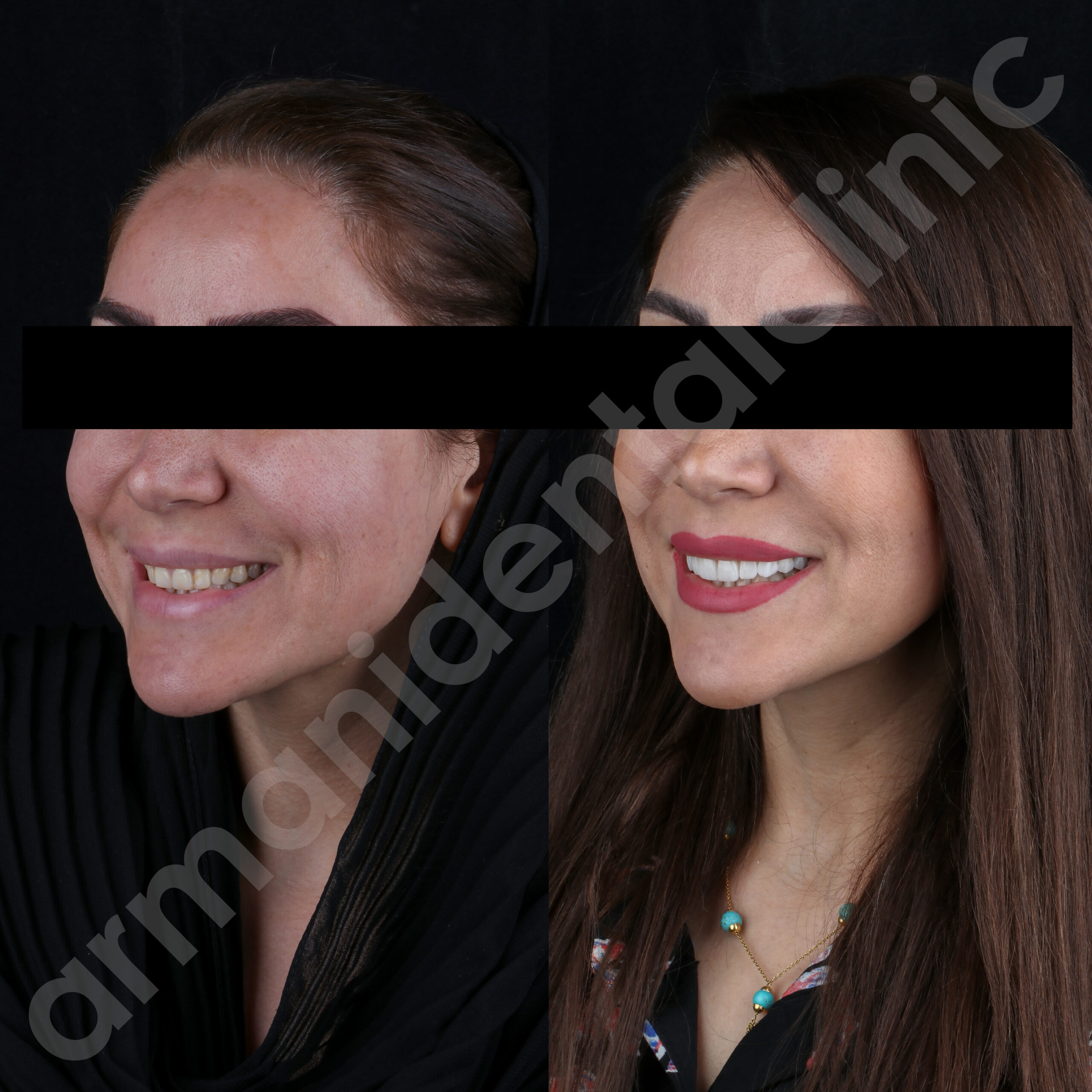 عکس لمینیت دندان قبل و بعد 