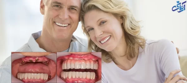 بهداشت روکش های ایمپلنت