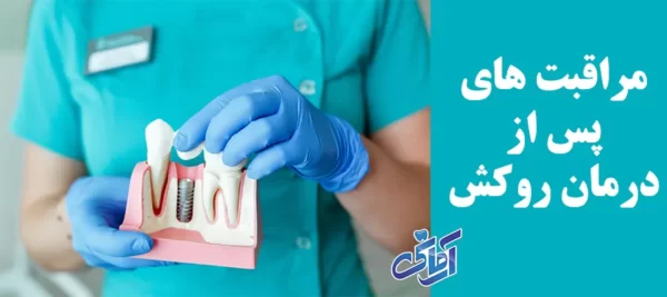 مراقبت های پس از درمان روکش 