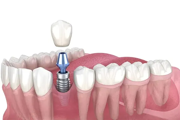مراقبت های پس از دریافت روکش ایمپلنت 1 مراقبت های پس از دریافت روکش ایمپلنت