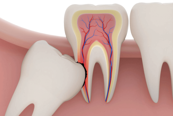 جراحی دندان نهفته 1 جراحی دندان نهفته
