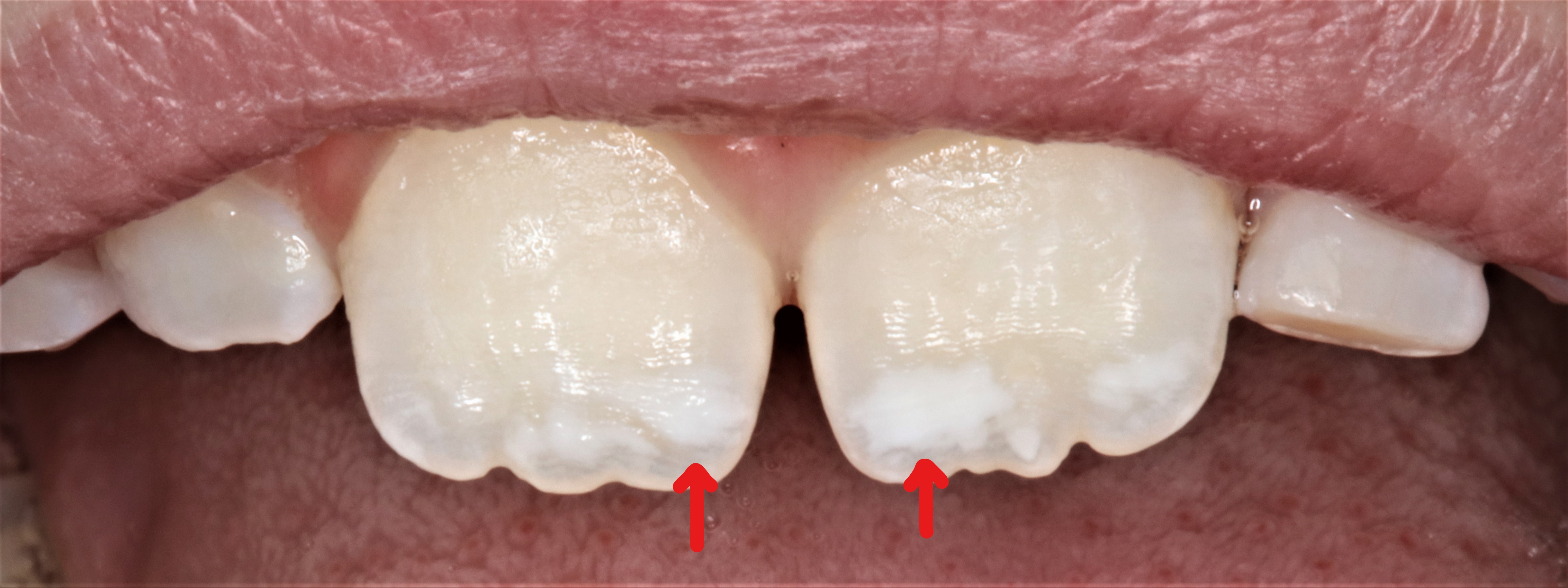  لکه سفید بر دندان کودکان