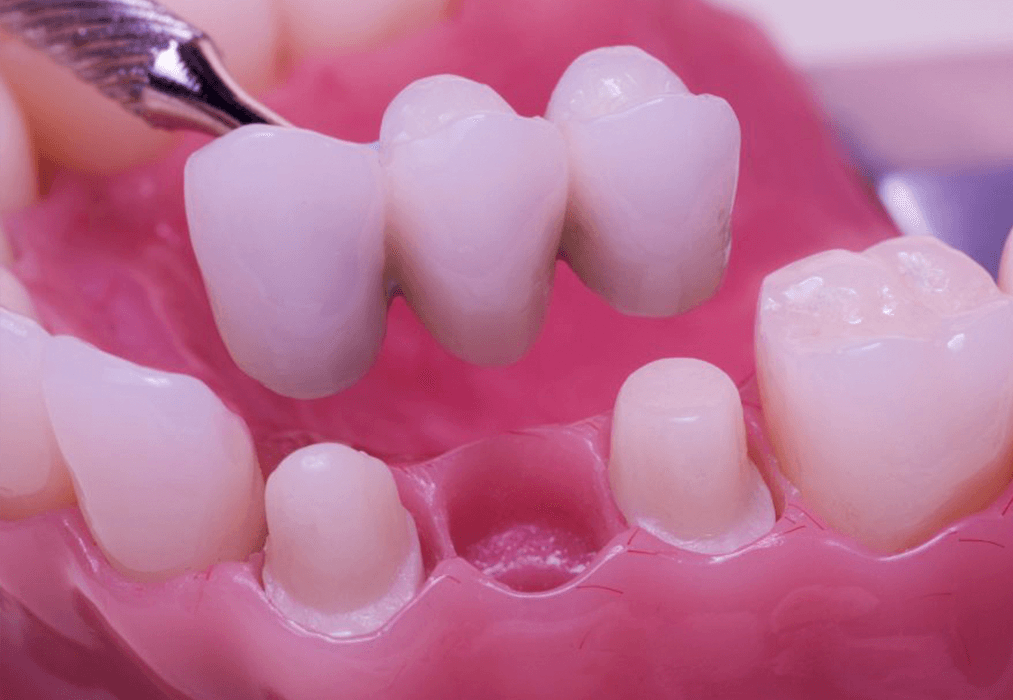 پروتز های ثابت و متکی بر دندان ( روکش )