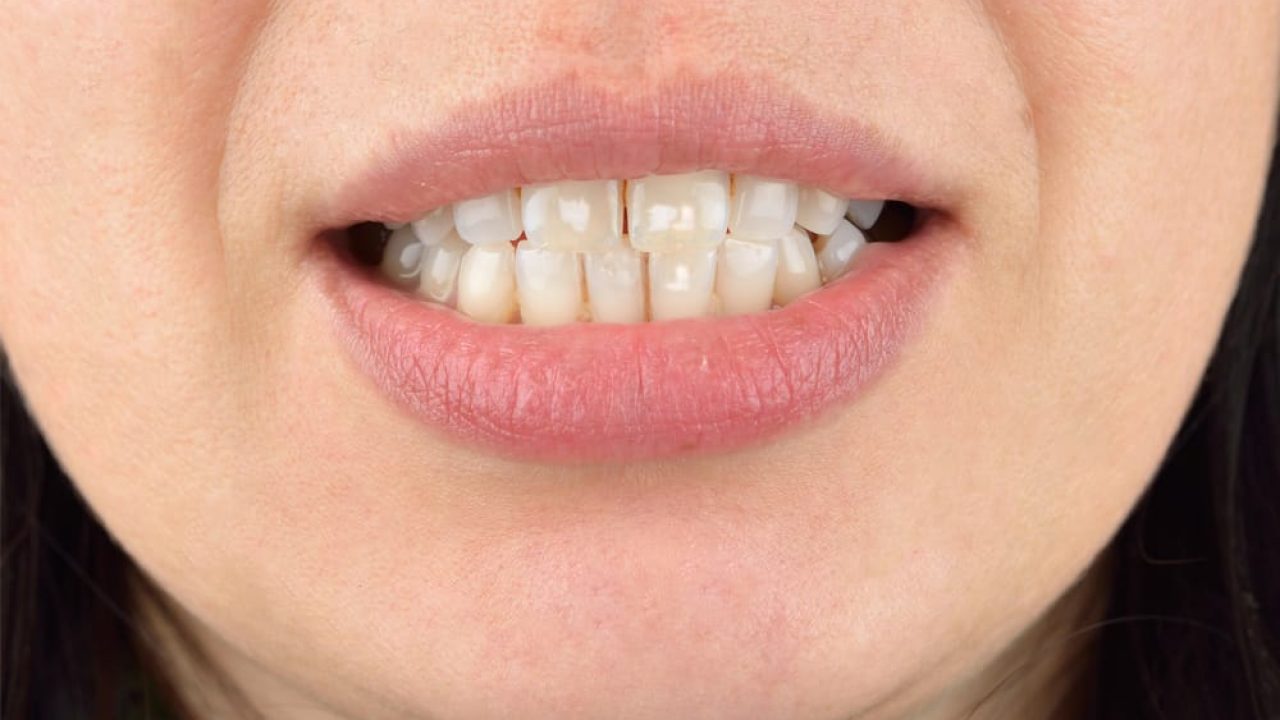 لکه های سفید نامرتب بر روی دندان ها