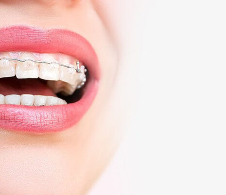 ارتودنسی ثابت 1 ارتودنسی ثابت