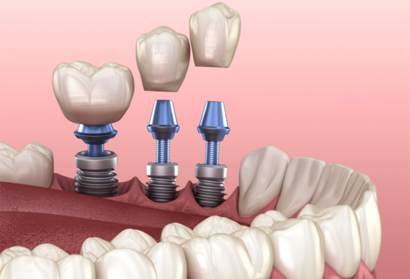 مراقبت پس از درمان ایمپلنت 1 مراقبت پس از درمان ایمپلنت