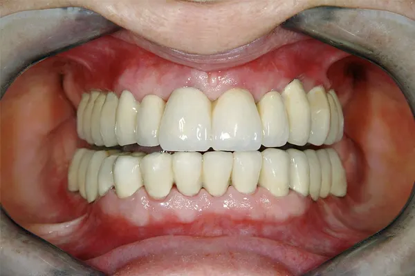 فواید کاشت دندان