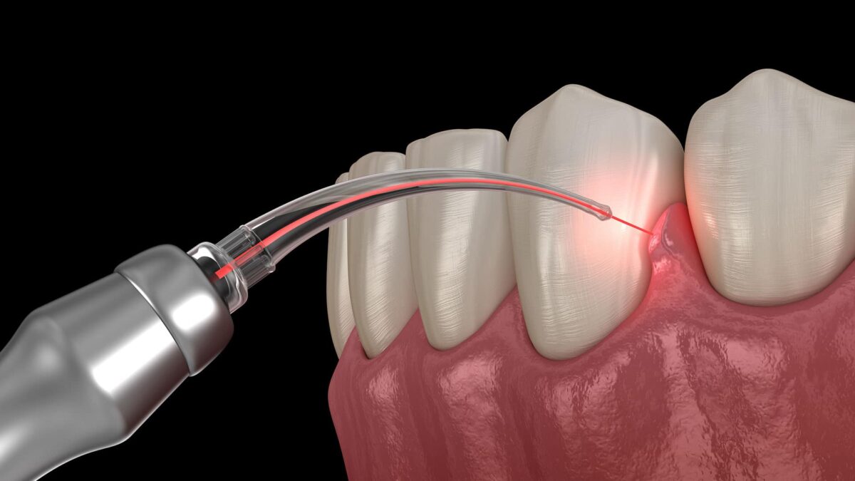 استفاده از لیزر در دندانپزشکی