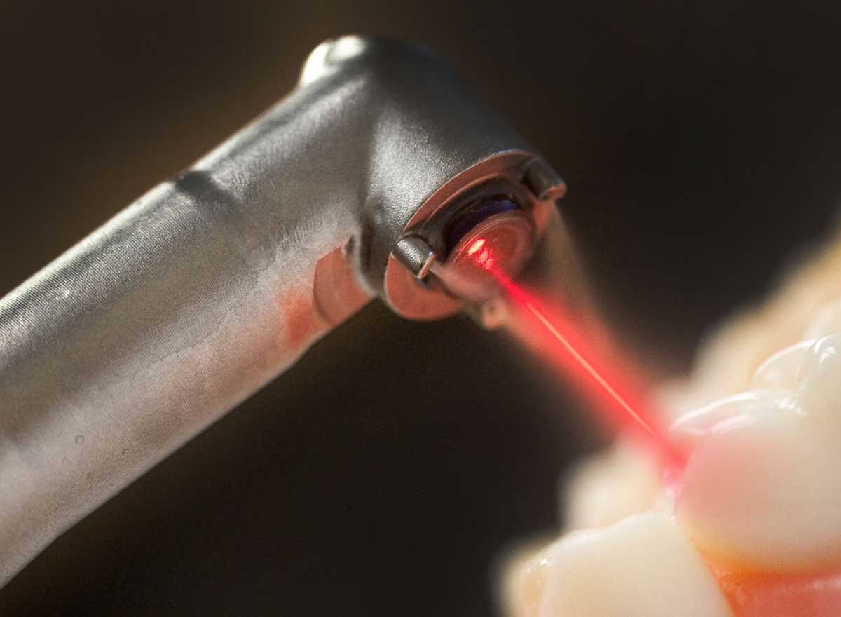 استفاده از لیزر برای جراحی دندانپزشکی