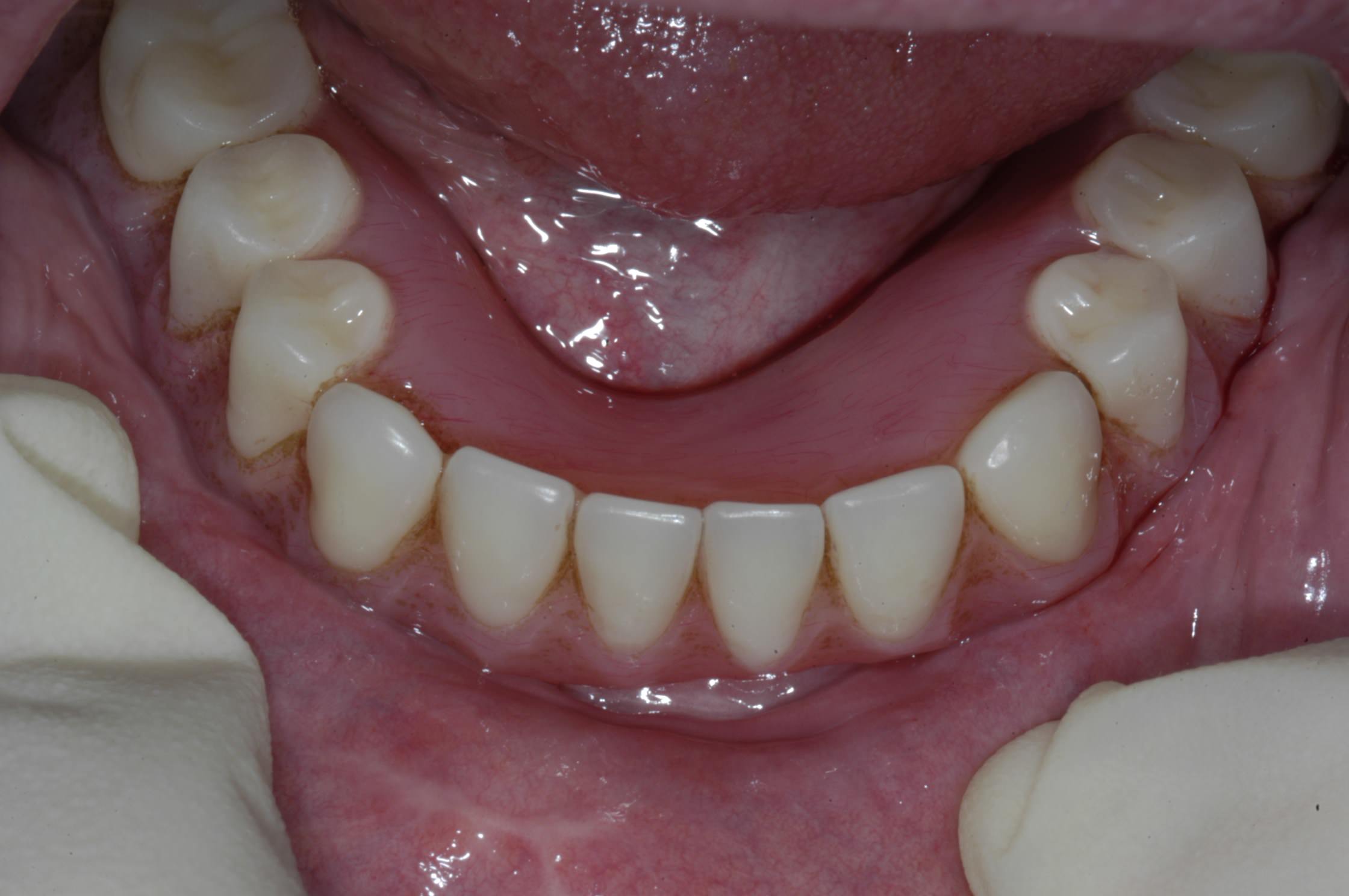 سازگاری دندان با دندان مصنوعی