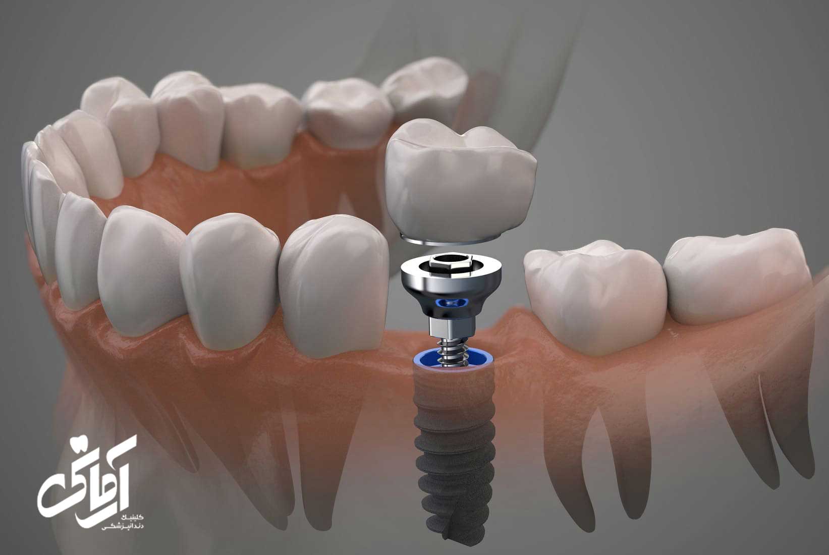 درد کاشت دندان چقدر است ؟ 7 روش مقابله با درد 1 درد کاشت دندان و کاشت ایمپلنت