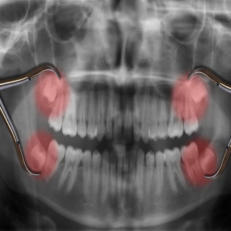 دندان عقل در نمایش به صورت ایکس ری