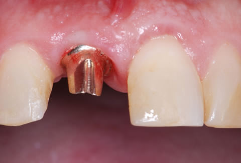 ایمپلنت دندان بدون روکش