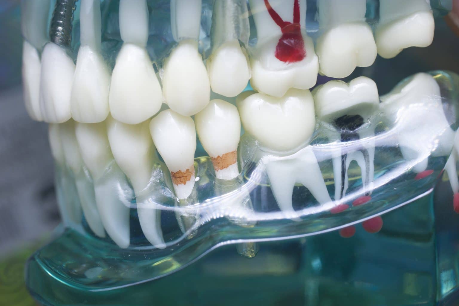 چرا دندان درد پس از تکرار درمان عصب کشی رخ می دهد؟