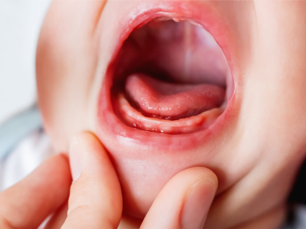 تورم لثه نوزاد در هنگام رشد دندان