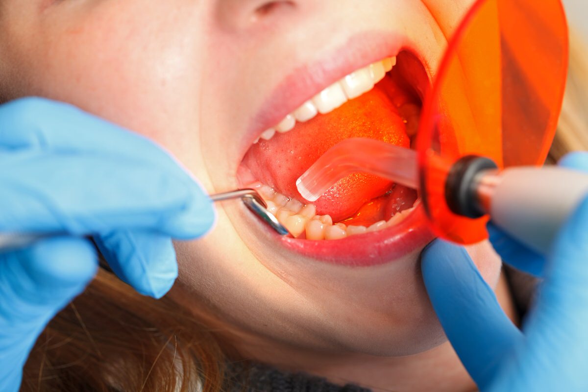 مواردی که پر کردن دندان و عصب کشی ضروری