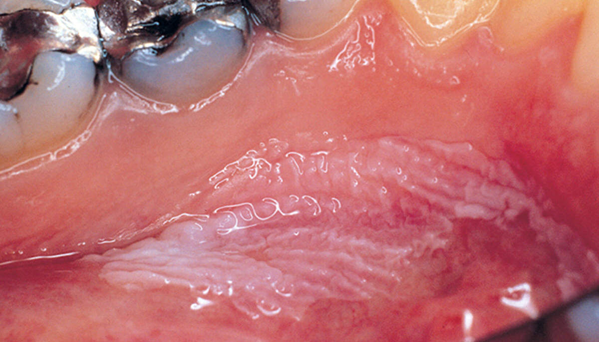 التهاب بین لثه و دندان