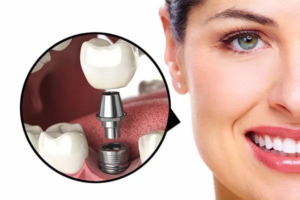مشکلات و عوارض ایمپلنت دندان 1 عوارض ایمپلنت دندان