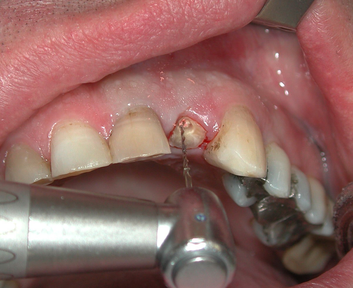 مشکل شدید در دندان